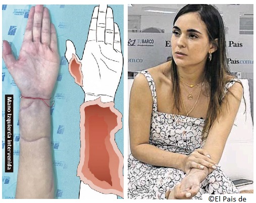 Parra and her scar